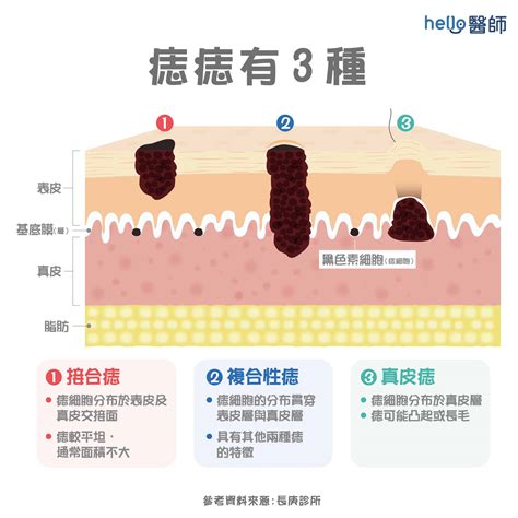 痣長在臉上|痣形成的原因？痣長毛、痣變多變大是痣病變？5招判。